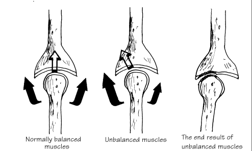 muscle imbalance